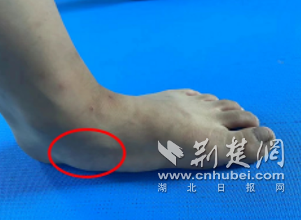 重复扭伤和腿部肿胀以