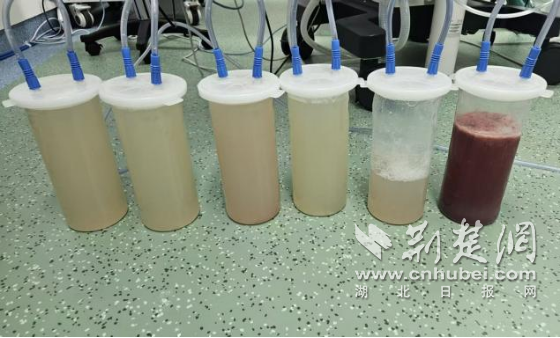 Xiangyang中央医院的儿科手术系成功地在Da Vinci机器